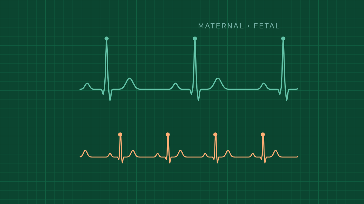 INVU heart-rate readings agreed closely with hospital CTG — Nuvo cover picture