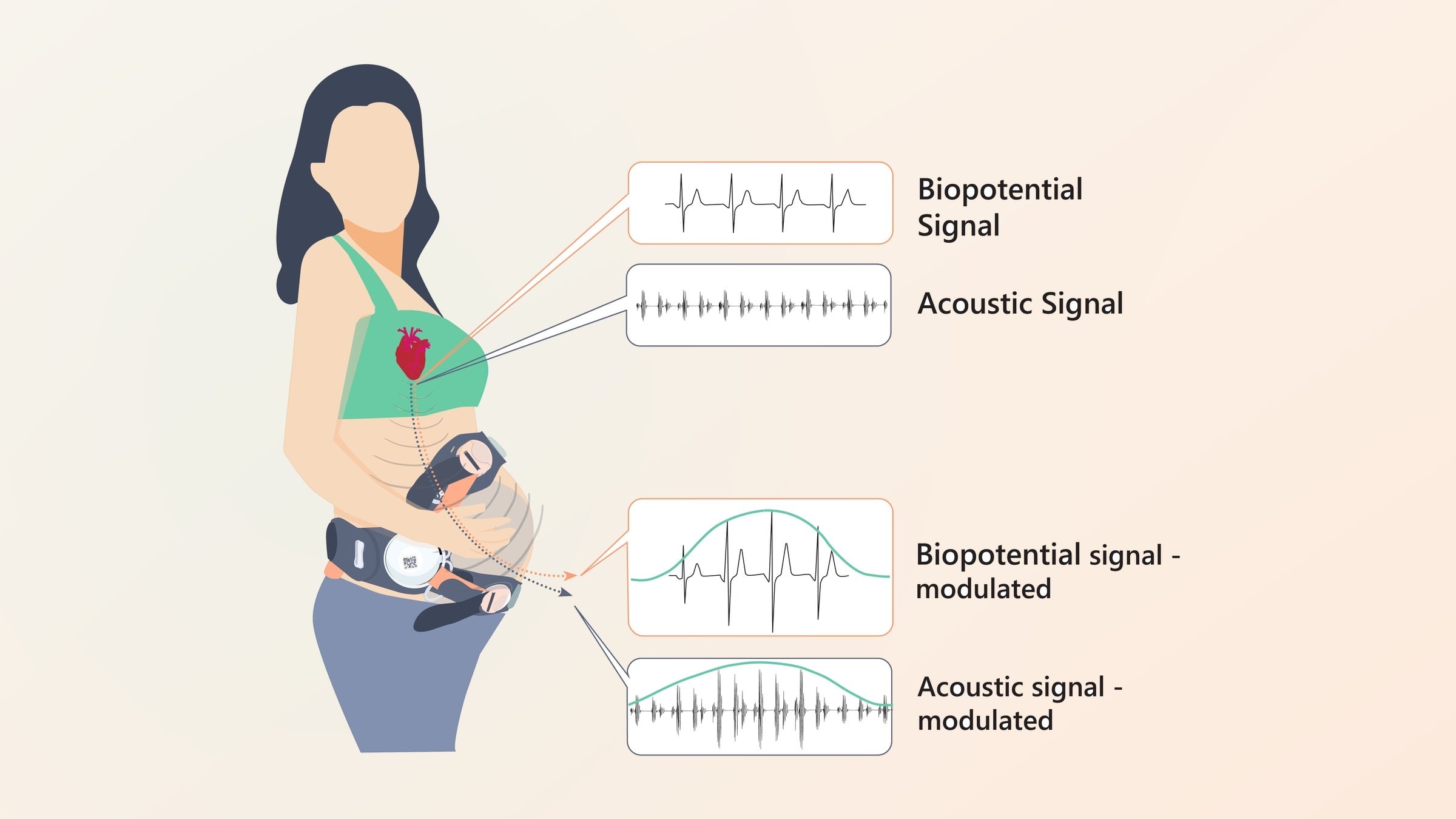 How INVU reads contractions: the mother’s heart signal, picked up as biopotential and acoustic signals, swells with each contraction
