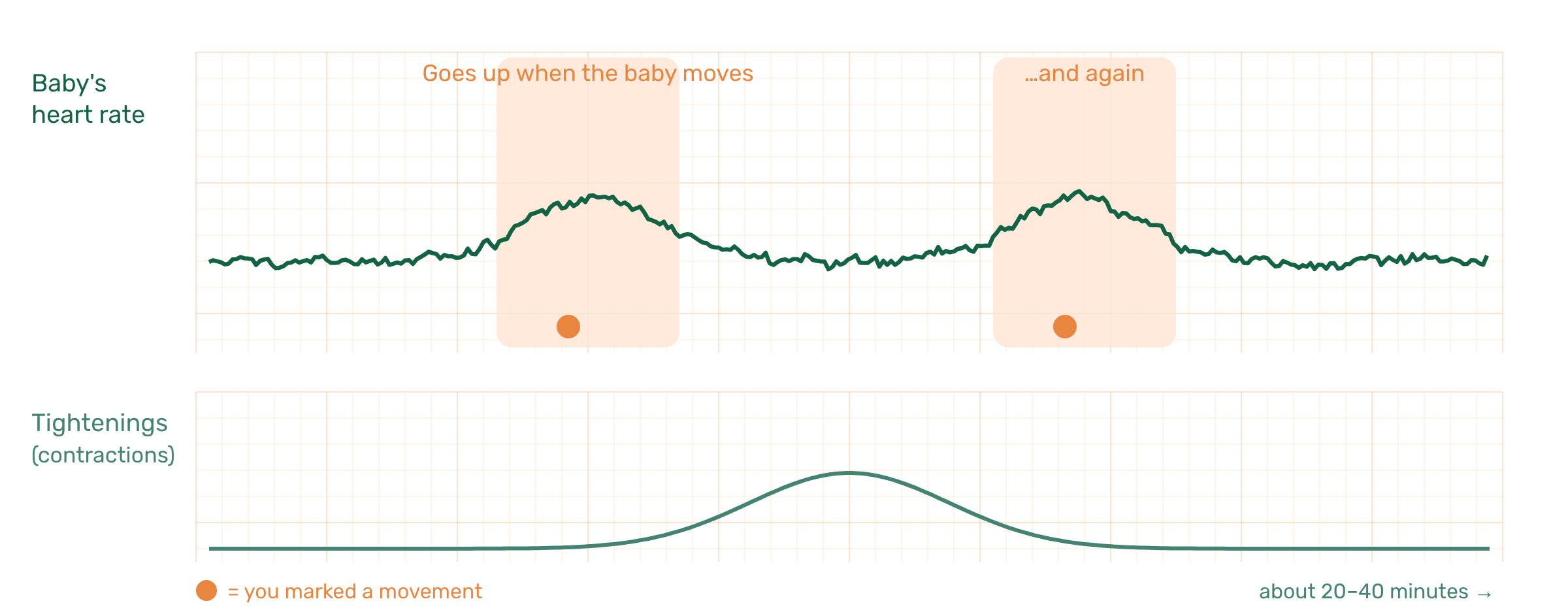 Illustration of an NST recording: the baby's heart rate rises twice when the baby moves; below, one gentle tightening